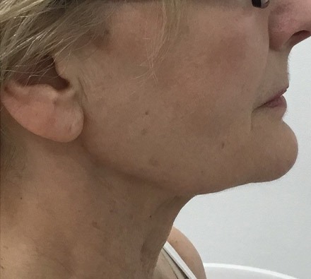 Ultherapy before and after (jowls)