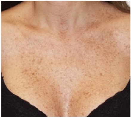 Décolletage pigmentation laser