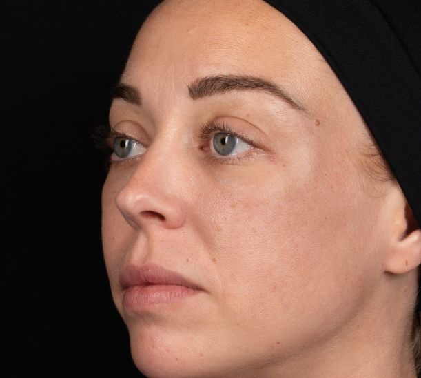 4 days after treatment