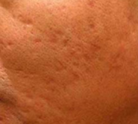 Before and after course of 6 Dermapen treatments