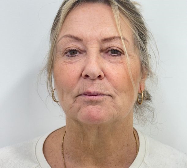 Quantum RF before and 10 weeks after treatment