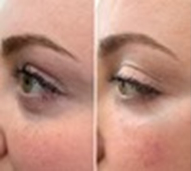 Polynucleotide eye treatment before and after