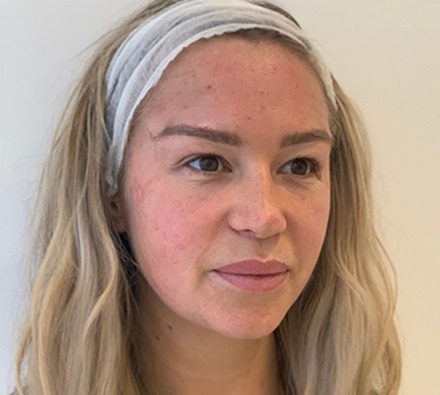 Fox eye lift before and after 
