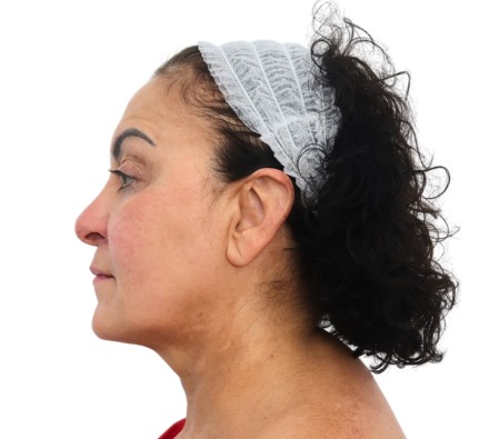 Before and after thread lift