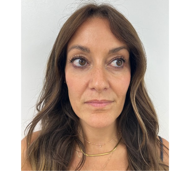 Before and after dissolving lip filler at Dr Leah Clinics