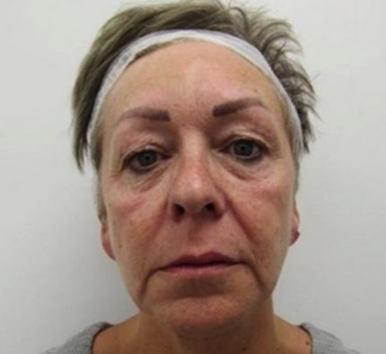 Before and after thread lift