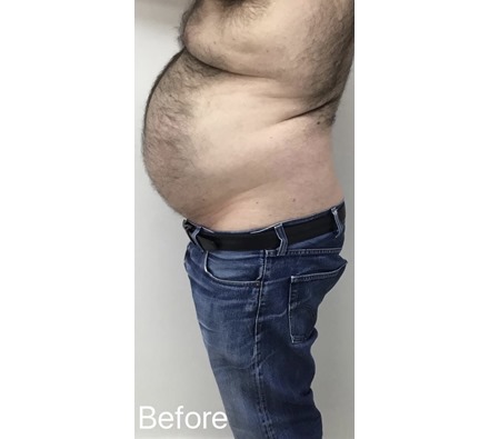 Fat freezing at Dr Leah Clinic (photos taken 8 weeks apart)