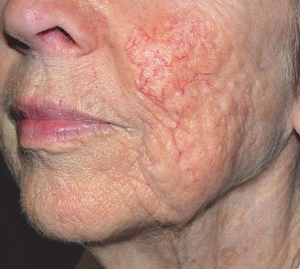 Facial redness before and after laser treatment
