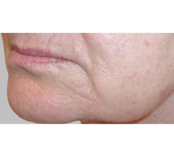 Before and After PRP Lower Jaw Therapy