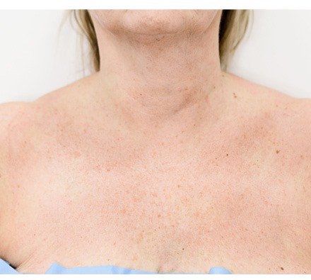 Lanluma V Decolletage Before & After 