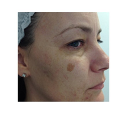 Pigmentation removal laser (sun spot removal)