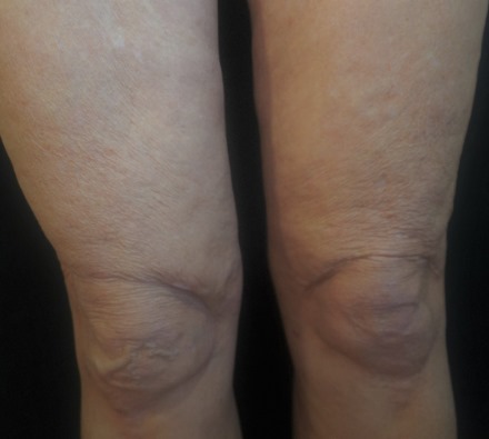 Legs Morpheus 8 Before and After, *Individual results may vary