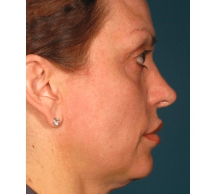 Ultherapy Full Face Before and After, *Individual results may vary