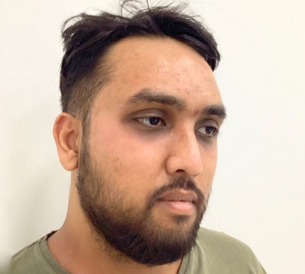 Before and after Obagi Nu-Derm skin transformation