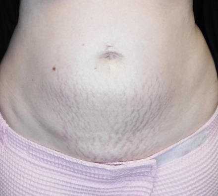 Stomach Morpheus8 Before and After, *Individual results may vary