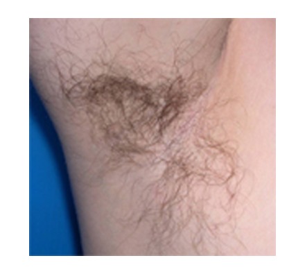 Soprano ICE underarm hair removal