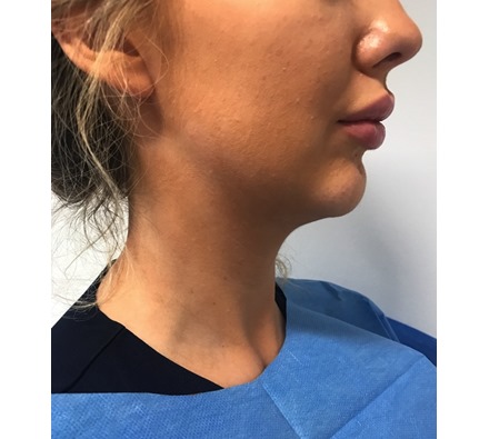 Before and after jawline filler