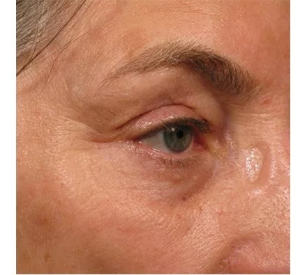 Ultherapy Eye Area Before and After, *Individual results may vary