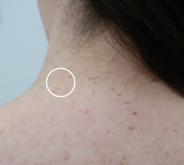 Mole removal before and after results
