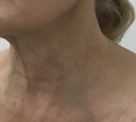 Ultherapy Neck Before and After, *Individual results may vary