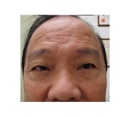 Lines on forehead and improvement to eye bags