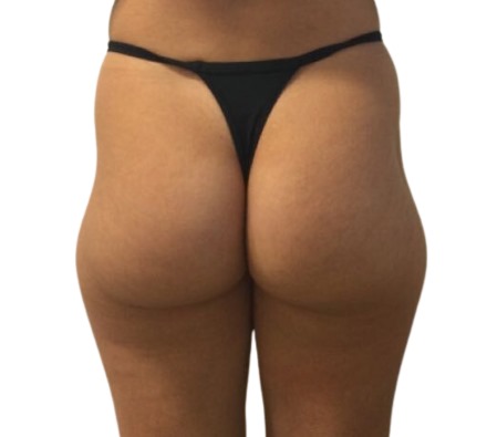 Before and after Lanluma non-surgical bum lift
