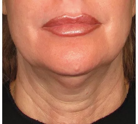 Ultherapy Neck Before and After, *Individual results may vary