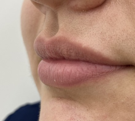 Lip filler (1ml MaiLi) before and after