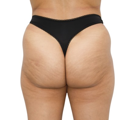 Lanluma Bum Lift Before and After