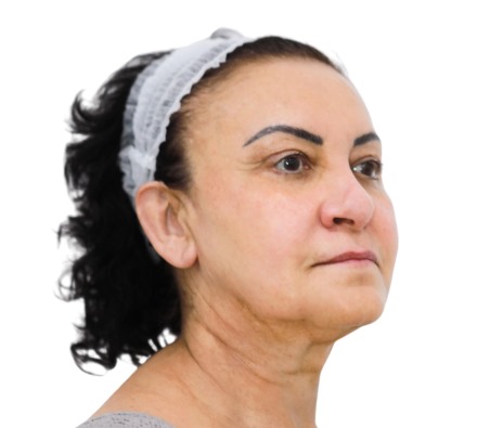 Before and after thread lift