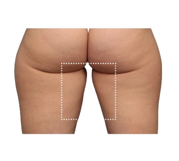 Dr Leah Clinics EmSculpt Neo thigh and bum lift and tightening before and after