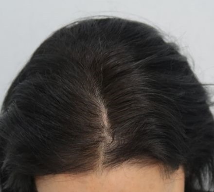 PRP Hair Loss Treatment Before and After