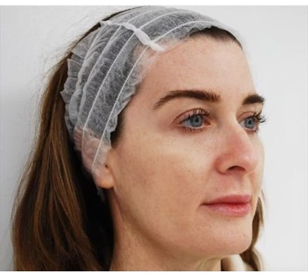 Before and after Profhilo treatment