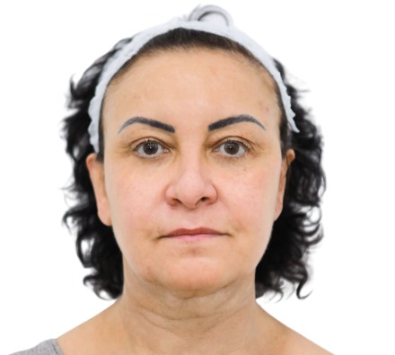 Before and after thread lift 