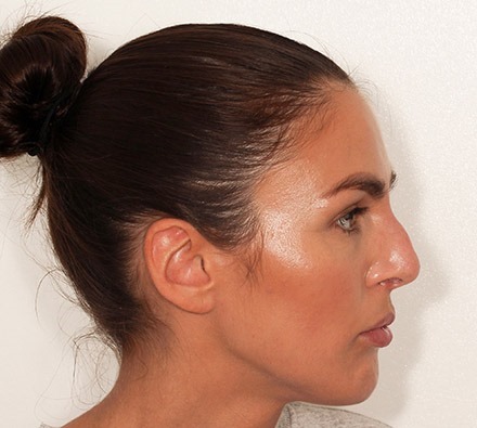 Before and After Non-surgical Rhinoplasty 