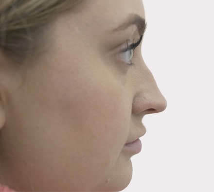 Nose filler before and after