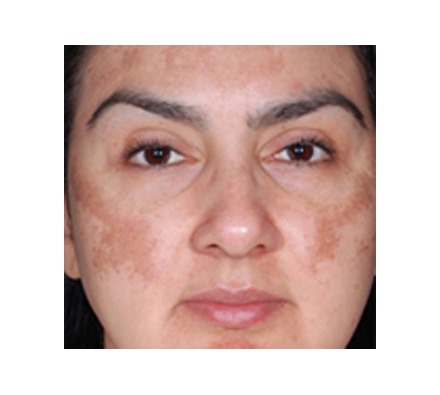 Obagi Nu-Derm results (12 week treatment)