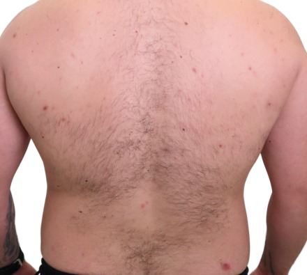 We treated this person's back acne with Hydr02 and an Obagi Blue Radiance Peel.