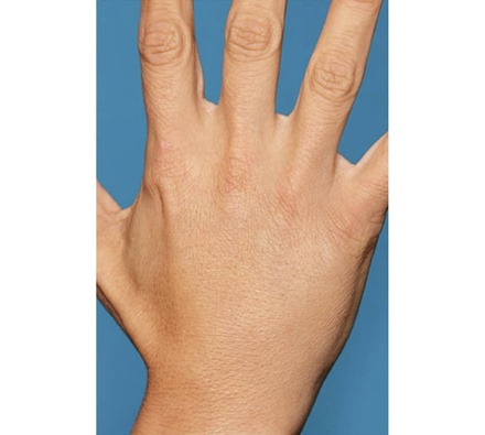 Ellanse dermal filler hand before and after