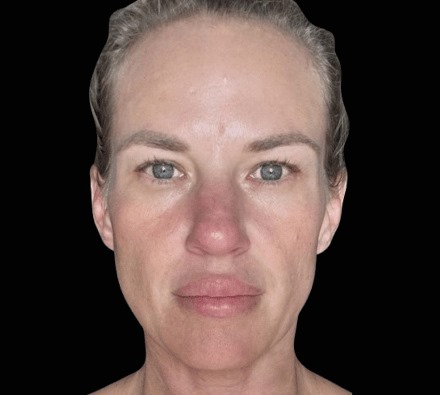 Before and After EmFace