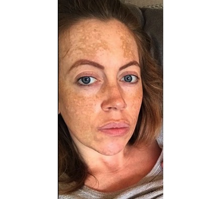 Obagi Nu-Derm before and after by Dr Leah Clinic