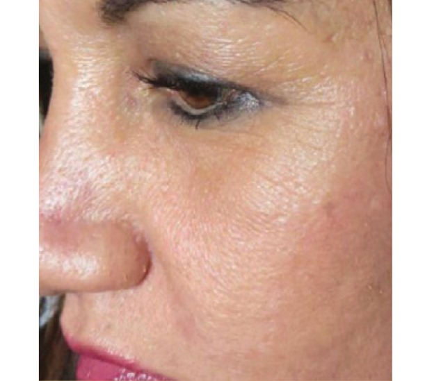 Before and After PRP Facial (vampire facial)