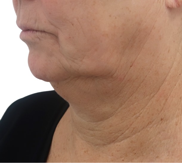 Quantum RF before and 10 weeks after treatment