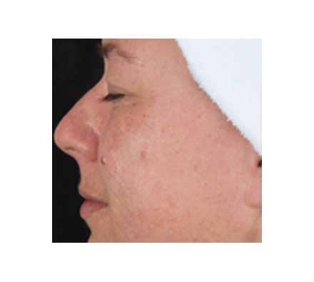 DermaClear (acne)