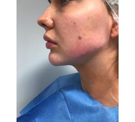 Before and after jawline and chin dermal filler
