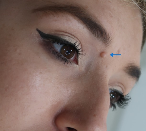 Before and after facial skin tag removed
