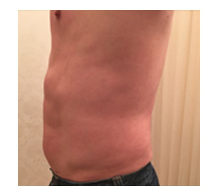 Fat dissolving injection