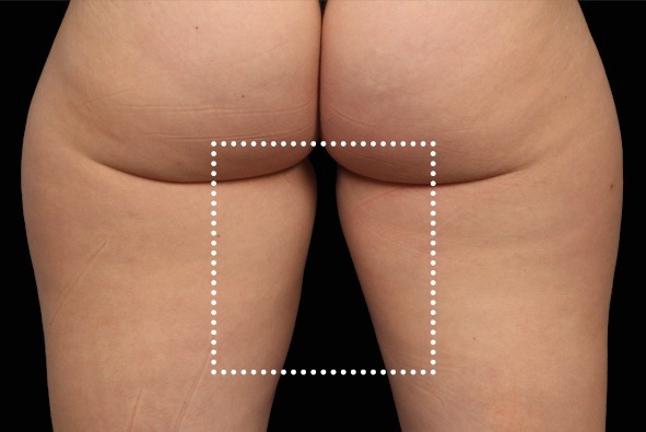 Thigh gap before and after EmSculpt Neo. Photos courtesy of Diane Duncan, M.D.