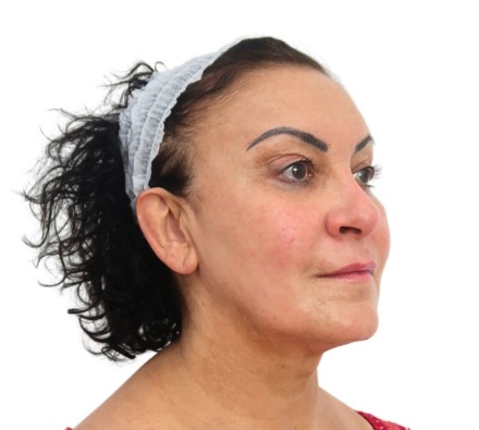 Before and after thread lift