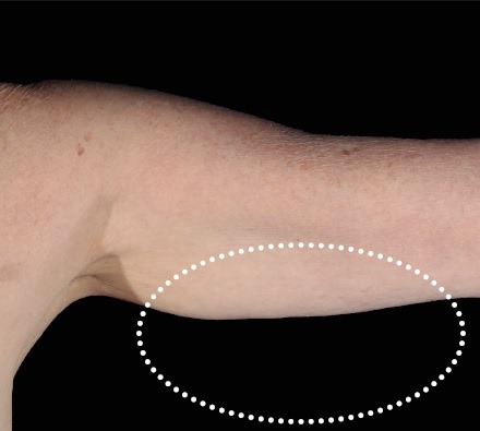 Female arm before and after Emsculpt Neo. Photos courtesy of Robert Weiss, M.D.